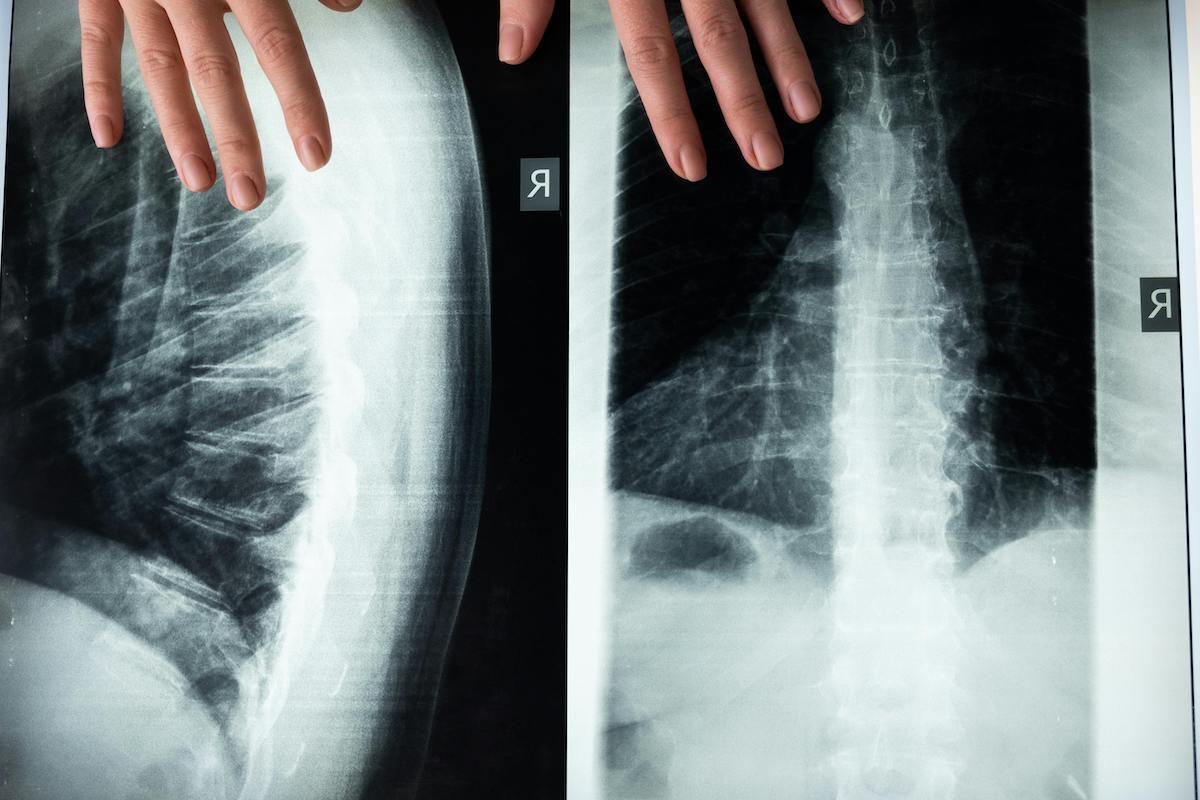 X-ray images of a human spine with visible vertebrae, accompanied by hands examining the scans.