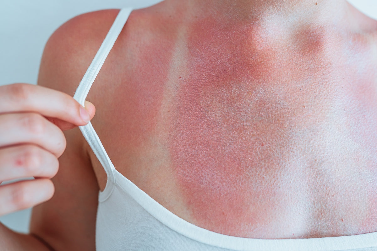 Close-up of a woman's sunburned chest and shoulder with visible swimsuit strap marks, highlighting skin damage caused by UV exposure.